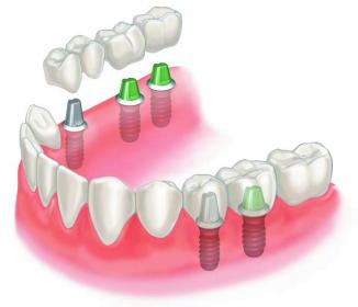 Незнімне протезування зубів, стоматолог ортопед, Дарницький район